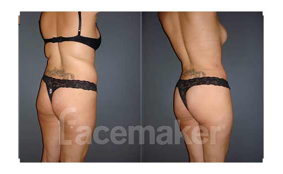 before and after liposuccion