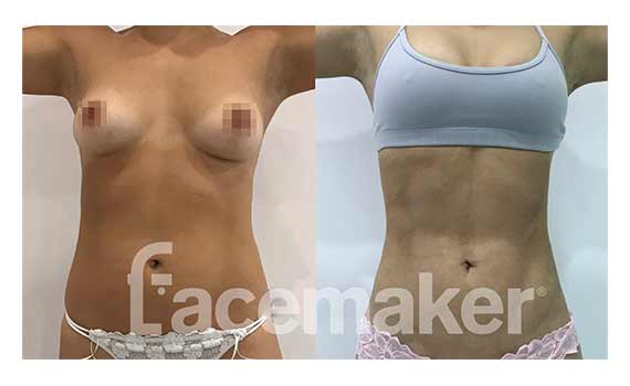 antes y después cirugia liposucción